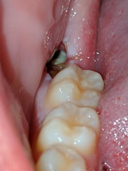 Alveolar osteitis or 'dry socket' Alveolar osteitis or 'dry socket'