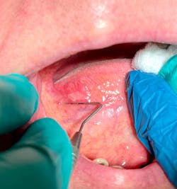 Squamous cell carcinoma Squamous cell carcinoma