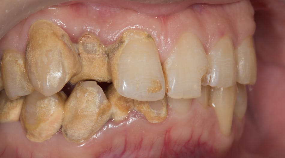 Calculus bridge: Do your patients know the risks? | Dentistry IQ