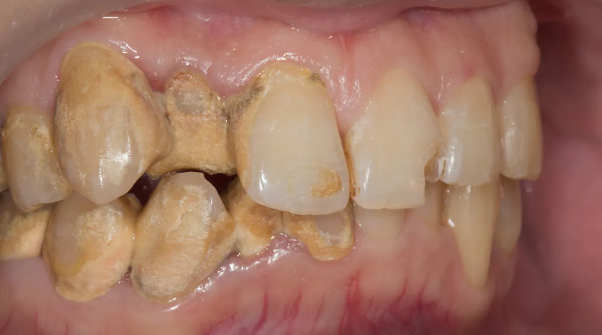 Calcules Brige Calculus bridge: Do your patients know the risks? | Dentistry IQ