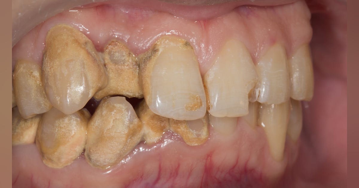 Calculus bridge: Do your patients know the risks? | Dentistry IQ