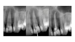 A tooth before and after root canal therapy. The middle image is the dentist&apos;s tool cleaning out the tooth.