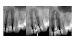 A tooth before and after root canal therapy. The middle image is the dentist's tool cleaning out the tooth. A tooth before and after root canal therapy. The middle image is the dentist's tool cleaning out the tooth.