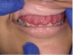 Figure 2: Painless swelling of the gingivae