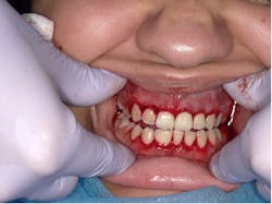 Figure 3: Gingivectomy Figure 3: Gingivectomy