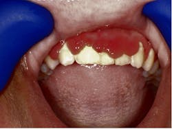 Figure 4: Two-week follow-up shows tissue has grown back Figure 4: Two-week follow-up shows tissue has grown back