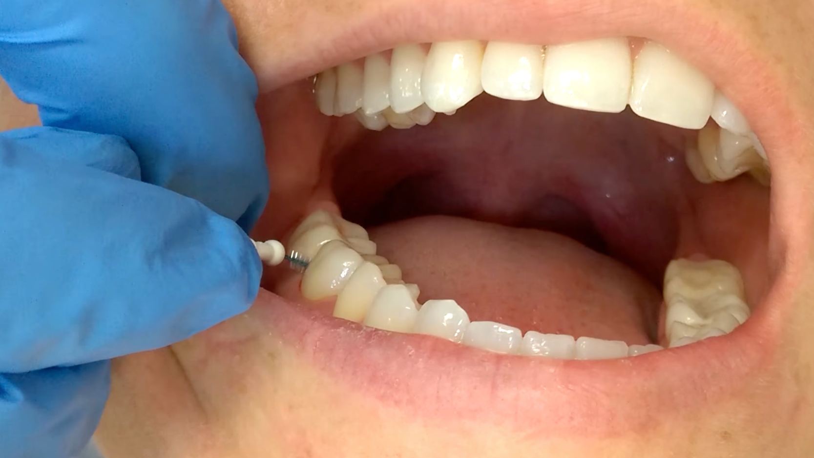 How to remove an overhang Dentistry IQ