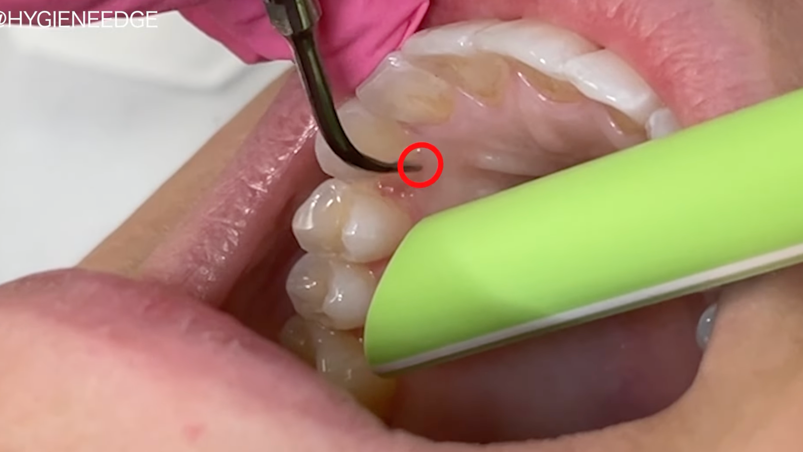 Getting comfortable with the piezoelectric scaler Dentistry IQ