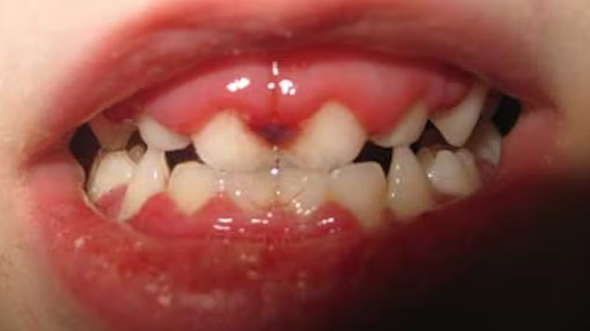 Pathology pack Lichen planus pemphigoides, angular cheilitis, and the