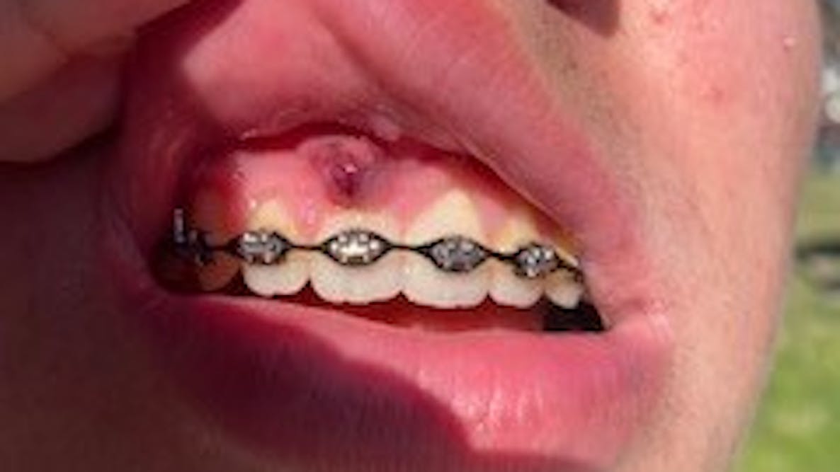 Wire poking out..quick solution before I can fix in on Monday : r/braces