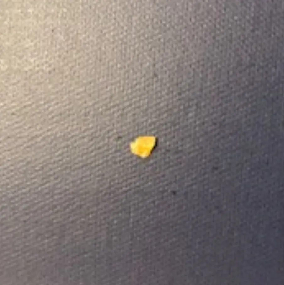 Popcorn Infection Periodontal abscess or gingival abscess? The perils of popcorn: A ...