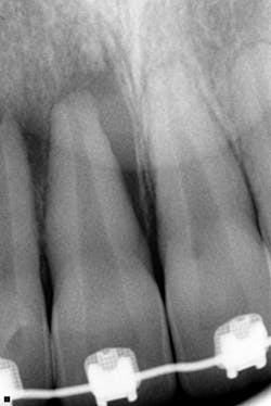 Figure 2: Periapical radiograph no. 8 Figure 2: Periapical radiograph no. 8