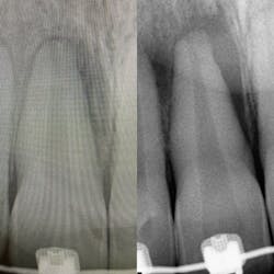 Figure 6: New periapical compared to original in May 2022 side by side