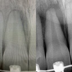 Figure 6: New periapical compared to original in May 2022 side by side Figure 6: New periapical compared to original in May 2022 side by side