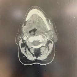Large, multilocated abscess collection on the inner surface of the left mandible (right side of picture) shown here on an axial-cut CAT scan. The path of this infection was through erosion of the lingual plate. Infections that form under the mandible are most commonly due to a necrotic mandibular first molar tooth.