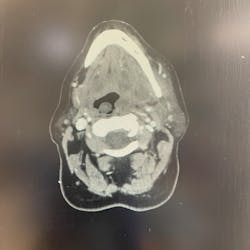 Large, multilocated abscess collection on the inner surface of the left mandible (right side of picture) shown here on an axial-cut CAT scan. The path of this infection was through erosion of the lingual plate. Infections that form under the mandible are most commonly due to a necrotic mandibular first molar tooth. Large, multilocated abscess collection on the inner surface of the left mandible (right side of picture) shown here on an axial-cut CAT scan. The path of this infection was through erosion of the lingual plate. Infections that form under the mandible are most commonly due to a necrotic mandibular first molar tooth.