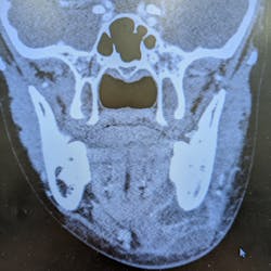 Coronal CAT scan demonstrating development of an abscess under the left mandible from an odontogenic source; in this case, a decayed molar tooth. Clinically, by the time this patient presented for treatment, the infection had extended all the way to the surface and was draining from the skin.