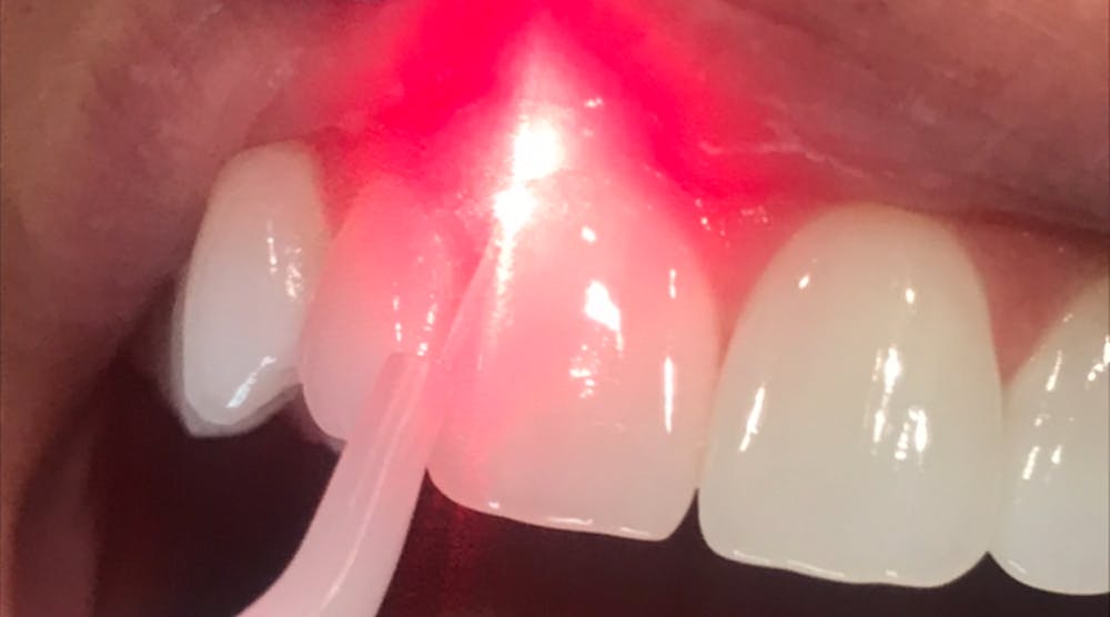 dental lasers