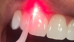 dental lasers dental lasers