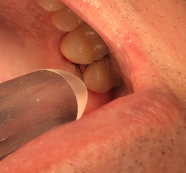 Figure 2: Laser-assisted periodontal therapy