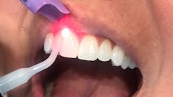 Laser bacterial reduction Laser bacterial reduction