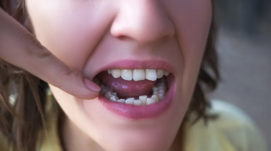 6 reasons teeth shift | Dentistry IQ