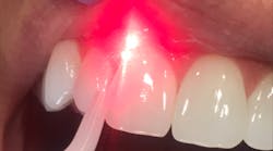 dental lasers dental lasers