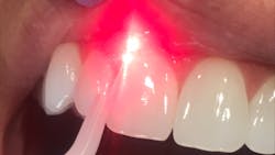 dental lasers dental lasers