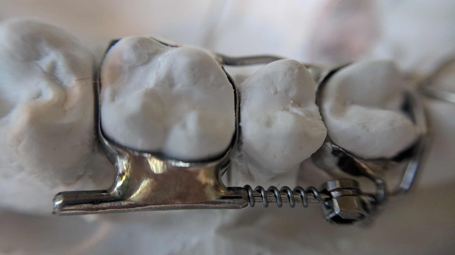 An Anterior Growth Guidance Appliance, or AGGA device, is photographed before it was used by Karan Gill, who wore the device for months and alleges in a lawsuit his teeth were left loose and sensitive. The AGGA&rsquo;s inventor and manufacturer have denied all liability in that lawsuit.