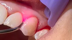 Laser