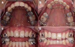 Photos of a 21-year-old man who has been affixed with an AGGA device and was examined by Dr. Kasey Li, a California maxillofacial surgeon. Li says images A and C show the patient at the start of his AGGA treatment and images B and D show the end, after the AGGA created gaps behind his canines.(Kasey Li)