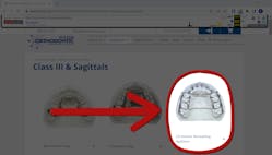 The LVI Anterior Remodeling Appliance, or ARA, is seen on the website of its manufacturer, Five Star Orthodontic, as shown on Internet Archive&rsquo;s Wayback Machine. Five Star Orthodontic no longer features the device on its website and declined to comment on the product.