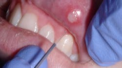 Canker sore Canker sore