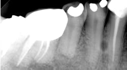 Mandibular Right Premolar Periapical