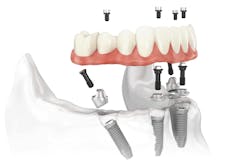 All On 4 Dental Implants All On 4 Dental Implants