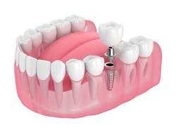 Dental Implant Image Dental Implant Image