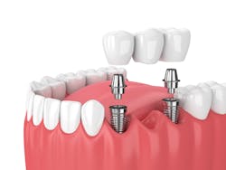 Dental Implant Supported Bridge Image Dental Implant Supported Bridge Image
