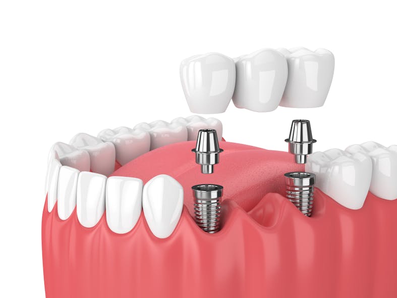 Dental Implant Supported Bridge Image