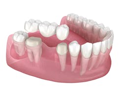 Dental Tooth Bridge Image