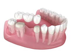 Dental Tooth Bridge Image Dental Tooth Bridge Image