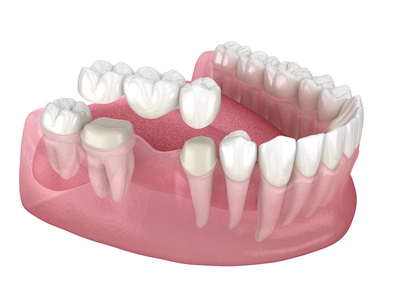Dental Tooth Bridge Image