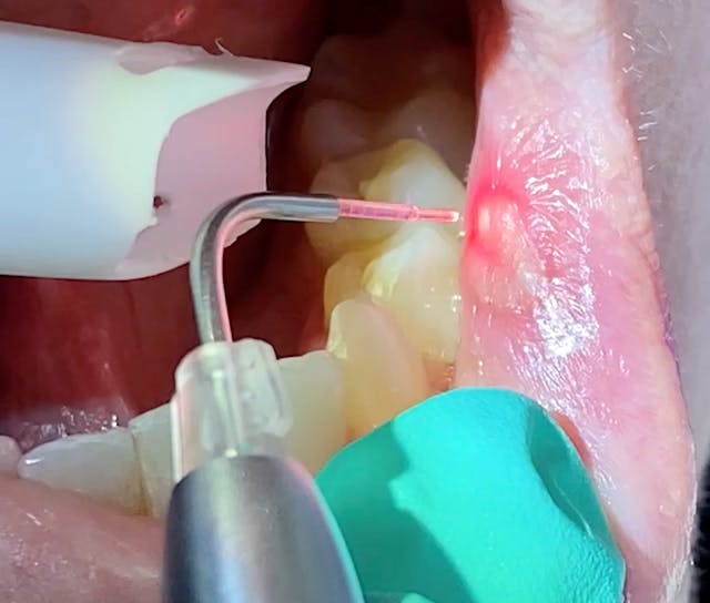 Laser procedures for dental hygienists Herpetic lesions and