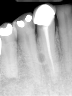 Periapical of mandibular right canine first premolar Periapical of mandibular right canine first premolar