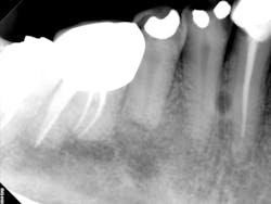 Periapical of mandibular right premolar Periapical of mandibular right premolar