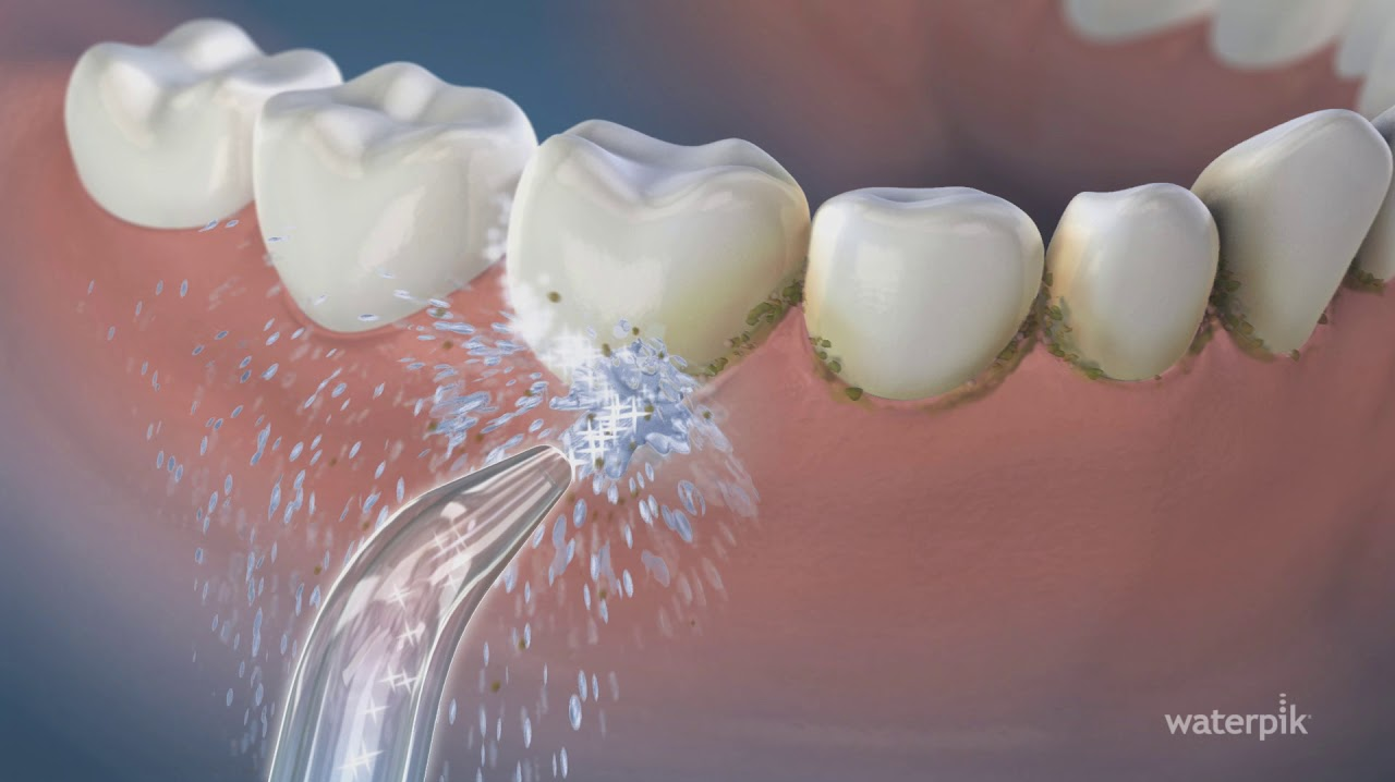 String floss vs. water flossing Dentistry IQ