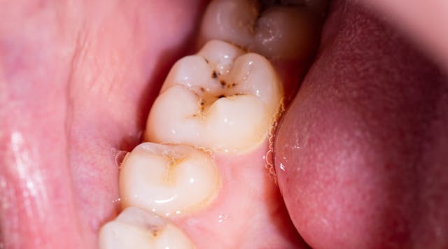 ADA's new tooth decay treatment guideline advises conservative approaches |  Dentistry IQ