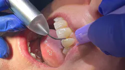 dental lasers used in dental hygiene