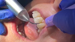 dental lasers used in dental hygiene dental lasers used in dental hygiene