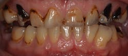 Figure 2: Young person with dry mouth, staining, and caries due to heavy smoking