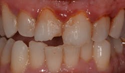Figure 3: Young person with sticky plaque and inflammation due to vaping and poor oral hygiene Figure 3: Young person with sticky plaque and inflammation due to vaping and poor oral hygiene